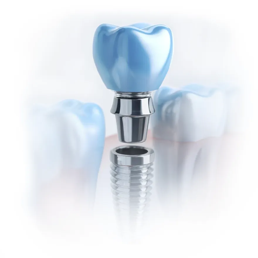Implante dental de titanio con corona cerámica — implantología guiada por ordenador en la Clínica Dental Mendizábal de Logroño